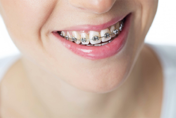 Braces and Aligners